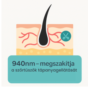 Miért jobb a 4 hullámhosszú diódalézer a tartós szőrtelenítéshez? 16 4 1